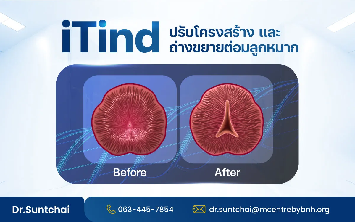 iTind หลังการรักษา